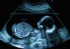 Parents Demand Abortion — Surrogate Fights Back Fetal ultrasound scan image