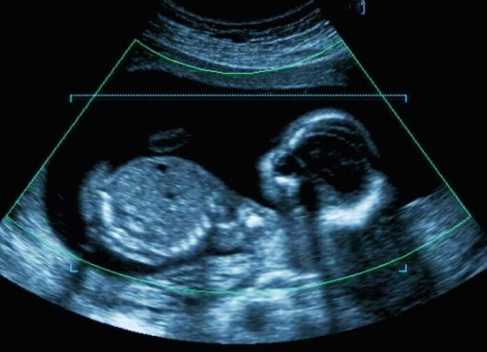 Fetal ultrasound scan image